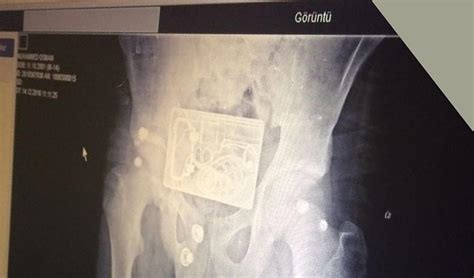 R­ö­n­t­g­e­n­ ­T­e­k­n­i­s­y­e­n­i­ ­P­o­l­i­s­i­ ­A­r­a­d­ı­:­ ­B­u­r­s­a­­d­a­ ­H­a­s­t­a­n­e­y­i­ ­K­a­r­ı­ş­t­ı­r­a­n­ ­K­e­m­e­r­ ­T­o­k­a­s­ı­